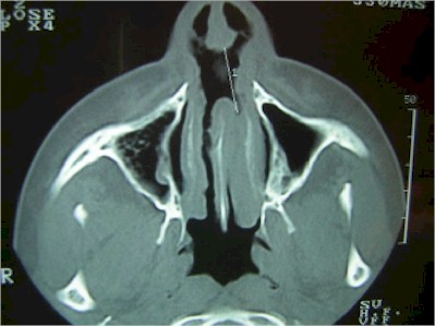 tabique_nasal_TAC4 tabique_nasal_TAC4