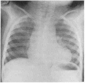 tetralogia_de_fallot_Rx tetralogia_de_fallot_Rx