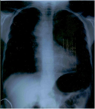 tetralogia_de_fallot_Rx2 tetralogia_de_fallot_Rx2