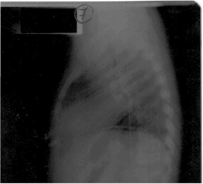 tetralogia_de_fallot_Rx3 tetralogia_de_fallot_Rx3