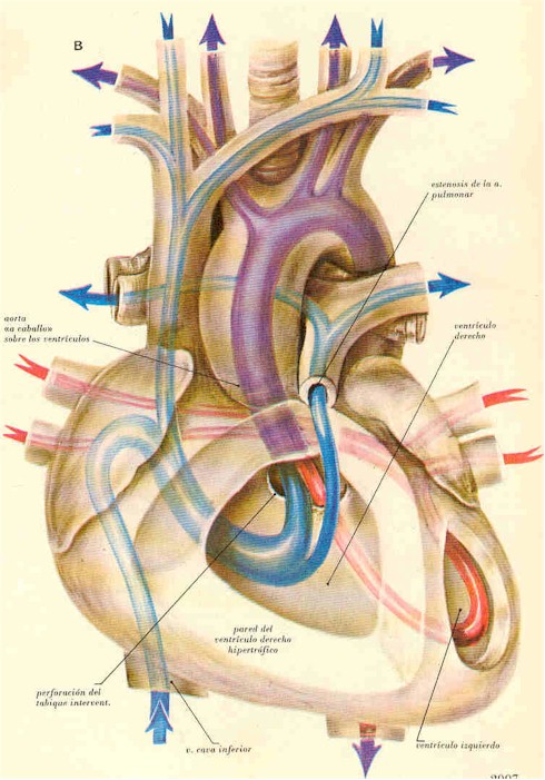 tetralogia_de_fallot_anatomia