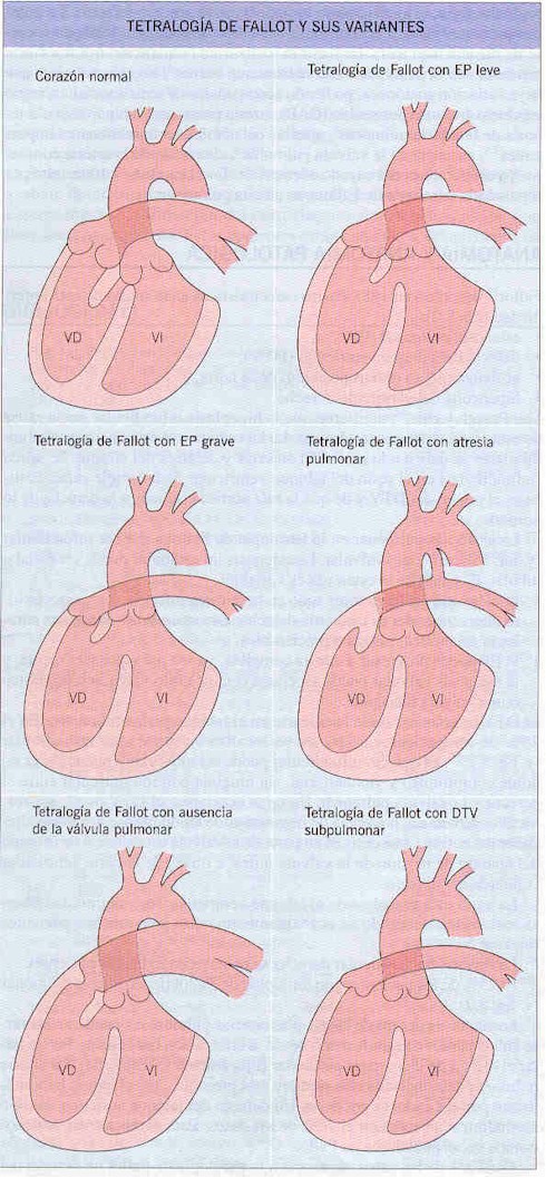 tetralogia_de_fallot_anatomia2 tetralogia_de_fallot_anatomia2