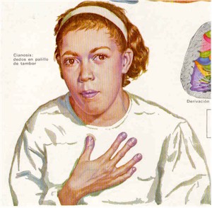 tetralogia_de_fallot_cianosis tetralogia_de_fallot_cianosis