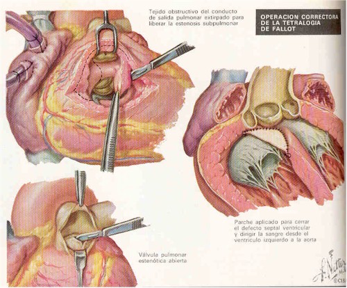 tetralogia_de_fallot_cirugia tetralogia_de_fallot_cirugia