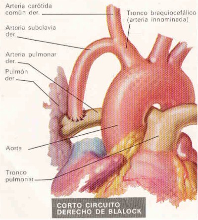 tetralogia_de_fallot_cirugia2 tetralogia_de_fallot_cirugia2
