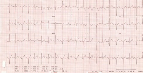 tetralogia_de_fallot/tetralogia_de_fallot_electrocardiograma tetralogia_de_fallot/tetralogia_de_fallot_electrocardiograma