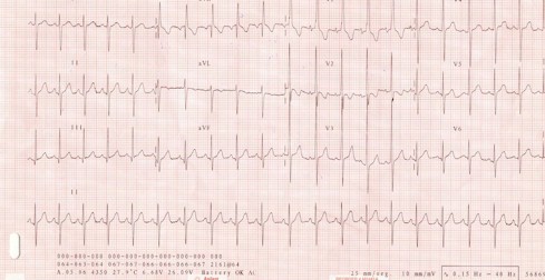 tetralogia_de_fallot/tetralogia_de_fallot_electrocardiograma