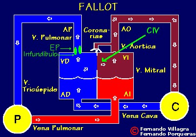 tetralogia_de_fallot_fisiopatologia