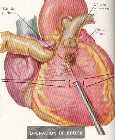 tetralogia_de_fallot_operacion_brock