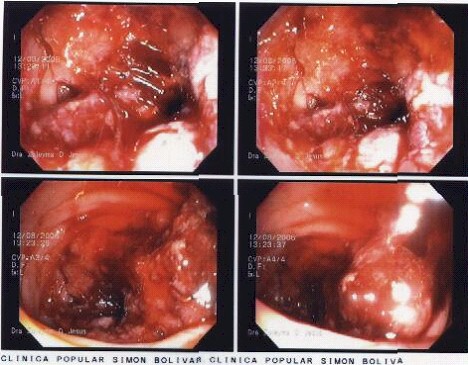 intususcepcion_colocolica intususcepcion_colocolica
