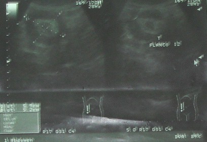 intususcepcion_colocolica3