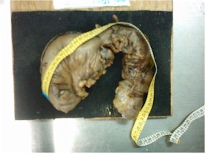 intususcepcion_colocolica_colon_izquierdo intususcepcion_colocolica_colon_izquierdo