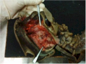 intususcepcion_colocolica_extension_tumor intususcepcion_colocolica_extension_tumor
