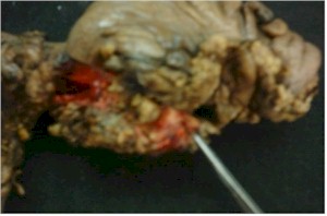 intususcepcion_colocolica_tumor_invaginado intususcepcion_colocolica_tumor_invaginado