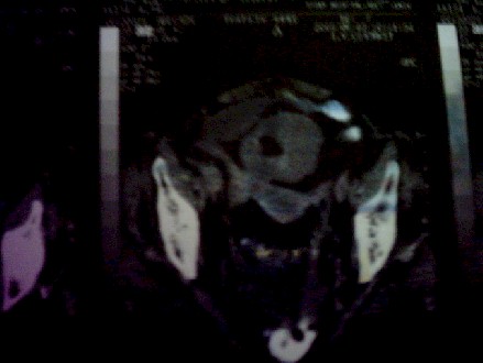 tuberculosis_abdominal_granulomatosa3