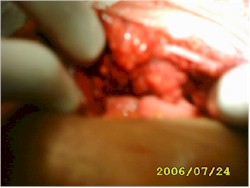tuberculosis_abdominal_granulomatosa_cirugia tuberculosis_abdominal_granulomatosa_cirugia