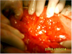 tuberculosis_abdominal_granulomatosa_cirugia2 tuberculosis_abdominal_granulomatosa_cirugia2