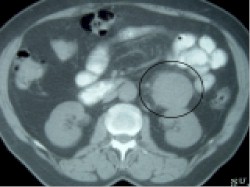 masa_retroperitoneal