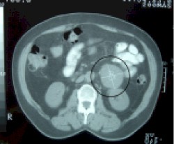 masa_retroperitoneal2