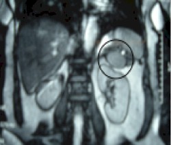 tumoracion_retroperitoneal_resonancia