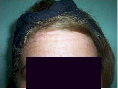 vitiligo2 vitiligo2