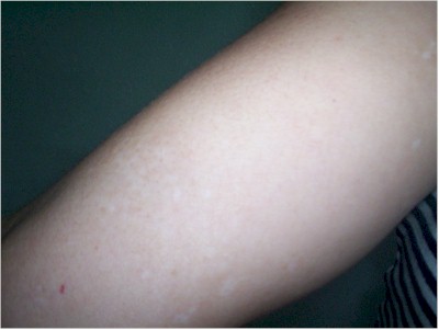 vitiligo3 vitiligo3