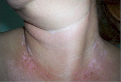 vitiligo4 vitiligo4