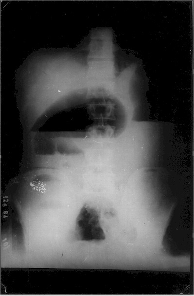 volvulo_colon_transverso_rx2 volvulo_colon_transverso_rx2