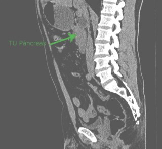 tumor_pancreas_caso/adenocarcinoma_cabeza_pancreas