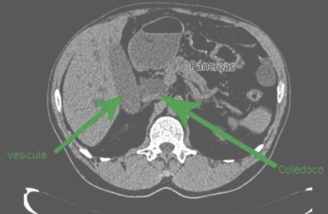 tumor_pancreas_caso/dilatacion_vesicula_coledoco