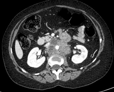 carcinoma_microcitico_ovario/TAC_adenopatias_retroperitoneales