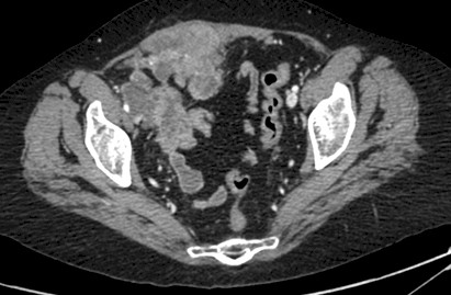 carcinoma_microcitico_ovario/TAC_carcinomatosis_peritoneal