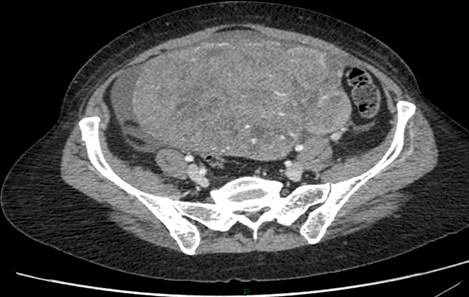 carcinoma_microcitico_ovario/TAC_masa_pelvica