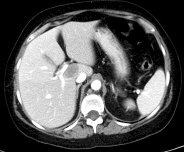 carcinoma_microcitico_ovario/TAC_metastasis_hepatica