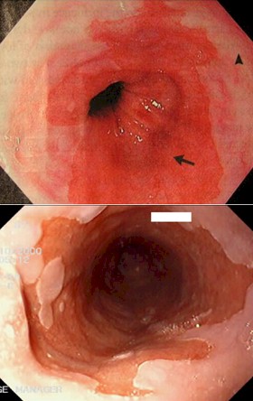 esofago_barret_ERGE/metaplasia_intestinal_endoscopia