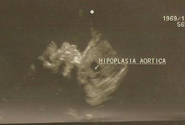 hipoplasia_cavidades_izquierdas/hipoplasia_aortica_ecocardiografia