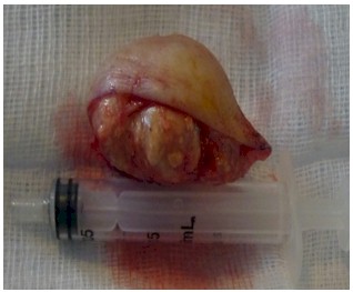 pilomatrixoma_frontal_tumoral/caso_ilustracion