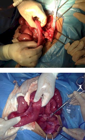 caso_obstruccion_intestinal/extraccion_quirurgica_intestinal