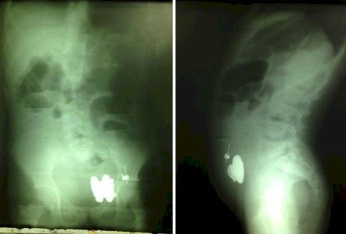 caso_obstruccion_intestinal/radiografia_Rx_cuerpo