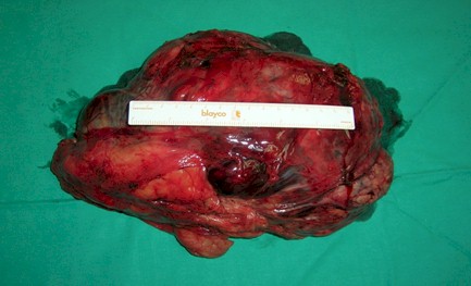 carcinoma_adrenocortical_gigante/cirugia_tumor_extirpacion