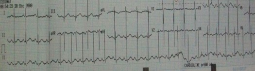 caso_anillos_vasculares/electrocardiograma_ECG_ritmo_sinusal