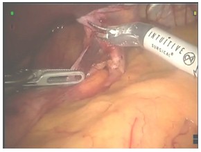 laparoscopia_ERGE_reflujo/extirpacion_saco_pilar