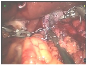 laparoscopia_ERGE_reflujo/fijacion_funduplicatura_pilar