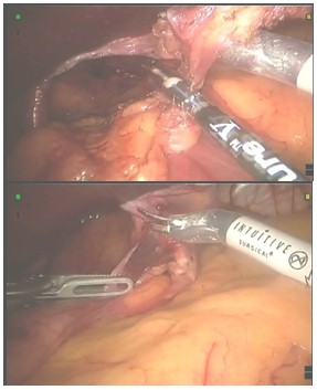 laparoscopia_ERGE_reflujo/final_extirpacion_saco