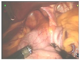 laparoscopia_ERGE_reflujo/identificacion_reduccion_estomago