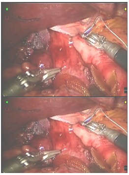 laparoscopia_ERGE_reflujo/inicio_fundiplicatura_Nissen