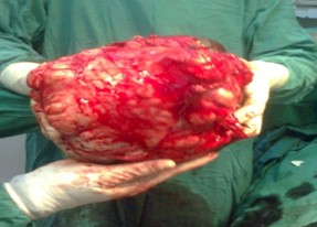sarcoma_sinovial_gigante/reseccion_quirurgica_tumor