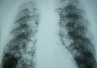 caso-linfangitis-carcinomatosa/infiltrado-pulmonar-bilateral