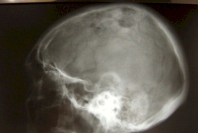 caso-linfangitis-carcinomatosa/metastasis-tumor-craneo