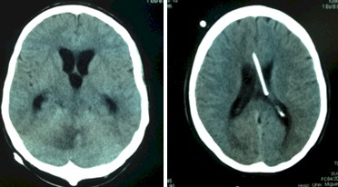 linfoma_cerebral_primario/TAC_cerebral_masa